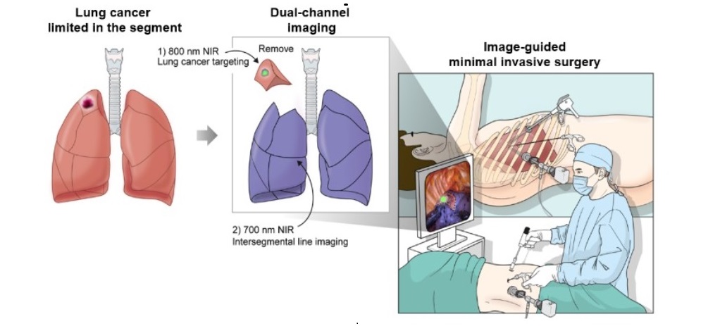 Image: Process of minimally invasive surgery (Photo courtesy of Korea University College of Medicine)